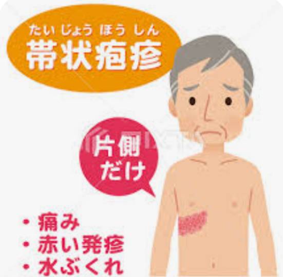 帯状疱疹ですか？治し方お伝えします